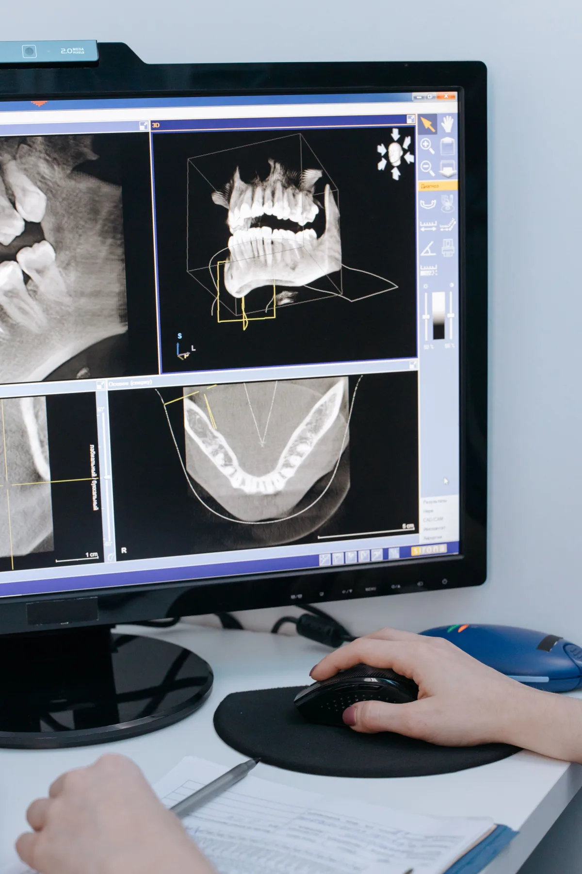 Dental implant planning X-ray image on a monitor for Orchard Smiles patients in Blackburn North