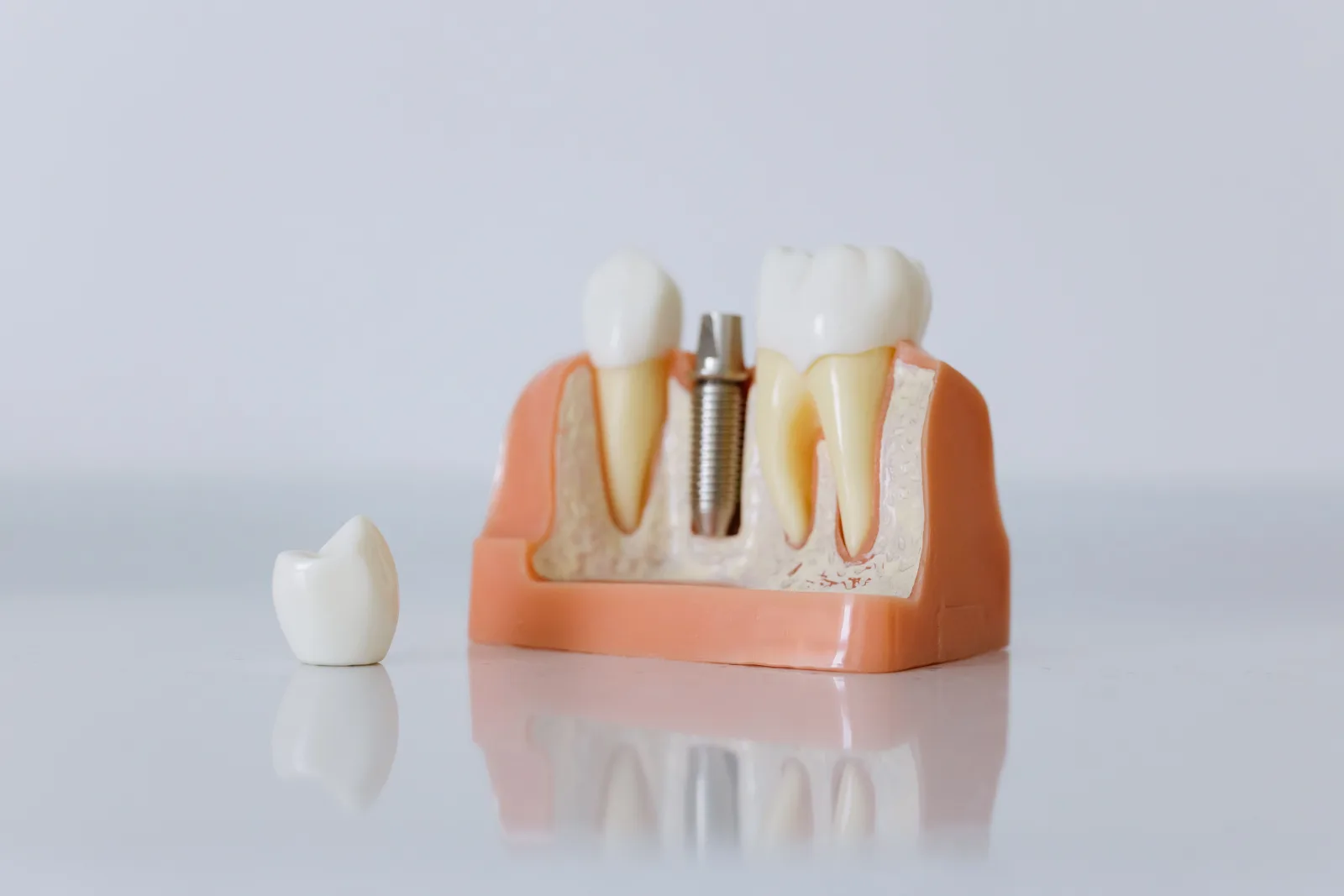 Dental implant model and replacement tooth used for missing tooth option information in Blackburn North