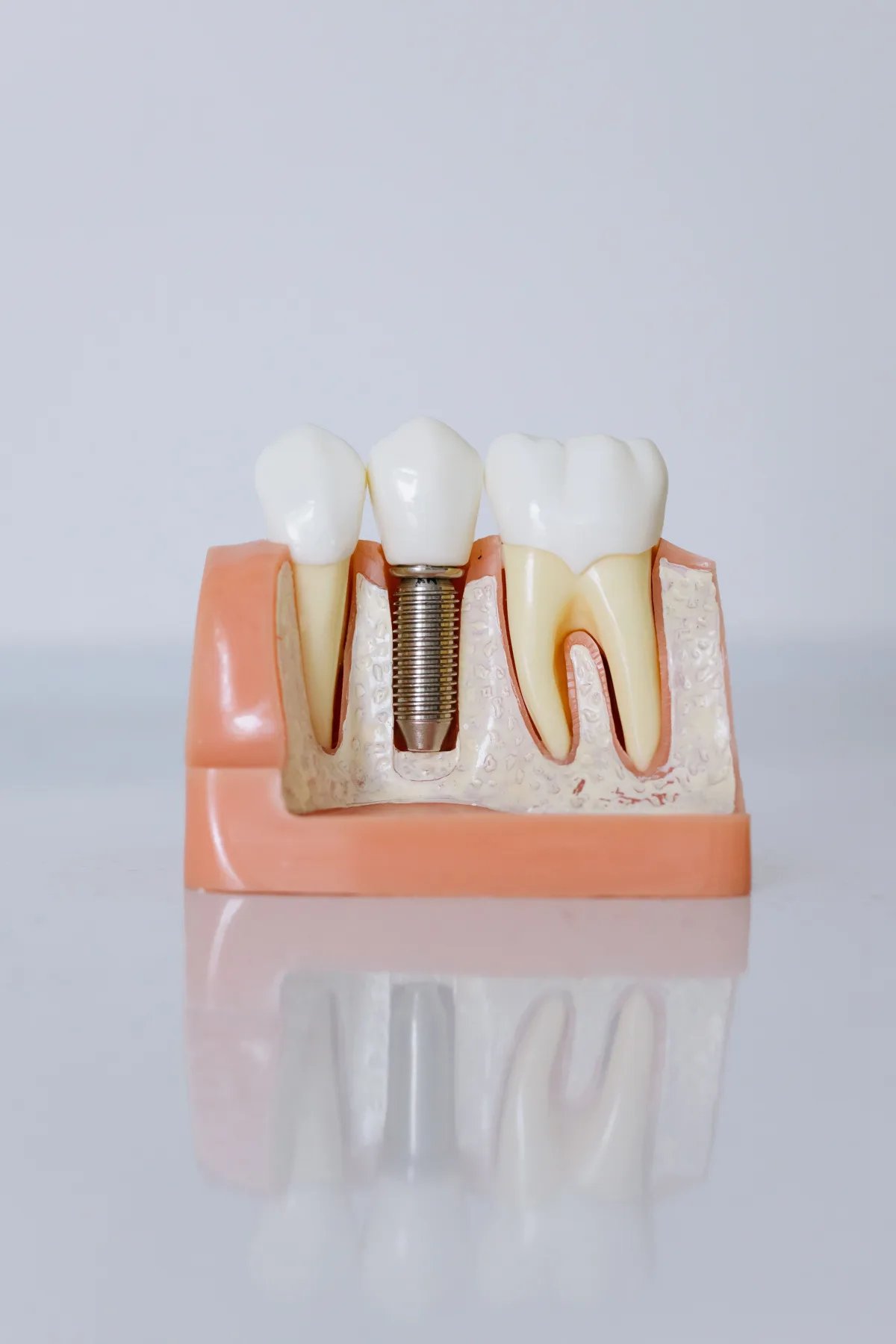 Single tooth dental implant model for implant crown planning information in Blackburn North